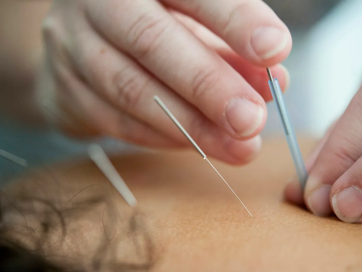 Acupuncture needles placed in the skin, close up